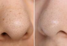 Clearer Skin, Smoother Nose: Effective Blackhead Removal and Skin Smoothing Techniques