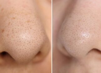 Clearer Skin, Smoother Nose: Effective Blackhead Removal and Skin Smoothing Techniques
