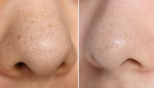 Clearer Skin, Smoother Nose: Effective Blackhead Removal and Skin Smoothing Techniques