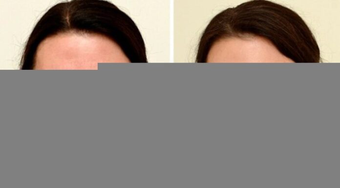 “Transform Your Skin in Just 1 Month: The Affordable Daily Drink That Gave a 45-Year-Old Woman a Stunning, Youthful Glow”