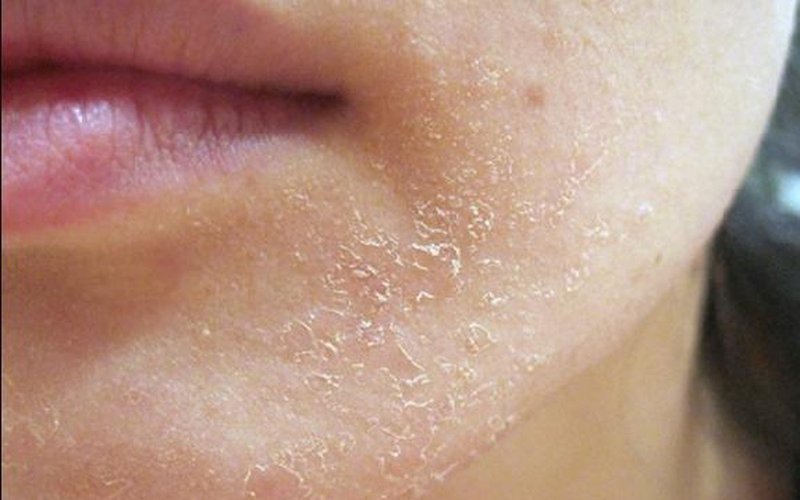 Revitalize Your Skin: 6 Simple At-Home Steps for Glowing, Hydrated Dry Skin