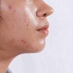 Achieving Clear Skin: A Step-by-Step Guide to Acne Care for a Flawless Complexion