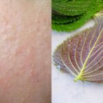 Banish Hidden Acne in Just One Week with This Common Market Vegetable