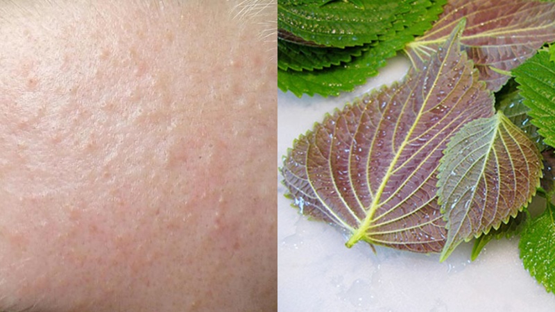 Banish Hidden Acne in Just One Week with This Common Market Vegetable